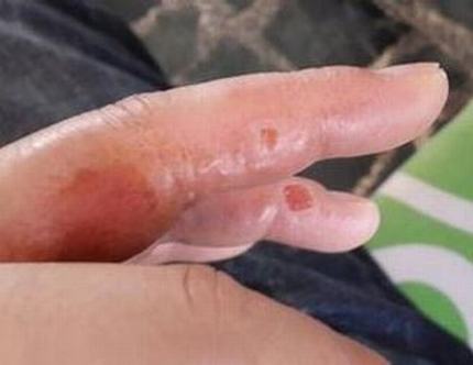 起了汗疱疹但不疼不痒正常吗