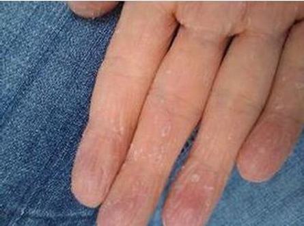 汗疱疹和手足癣的鉴别诊断是什么