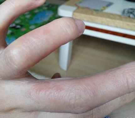 脚上长汗疱疹怎么办