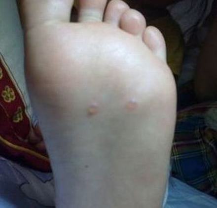 汗疱疹饮食上注意什么