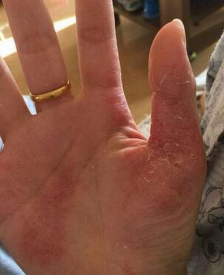 汗疱疹运动会好吗
