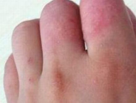 汗疱疹越来越痒怎么治疗