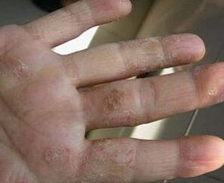 汗疱疹越来越鼓怎么办
