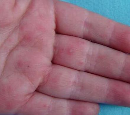 汗疱疹与手癣的区别