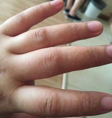 汗疱疹有哪些治疗的手法