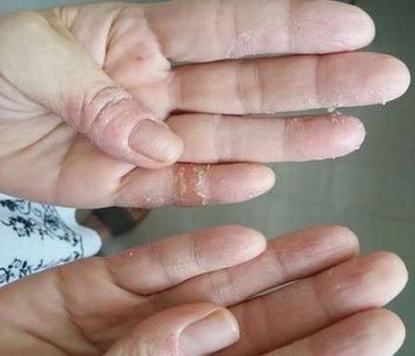 治疗汗疱疹的外用药