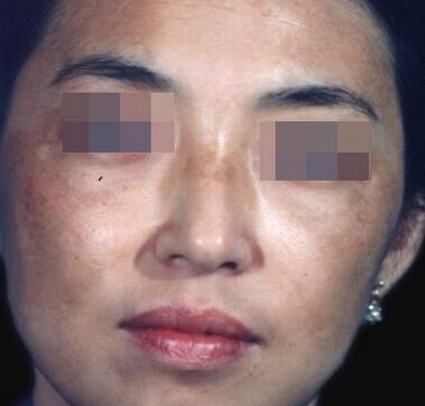 哈尔滨老中医治黄褐斑食疗