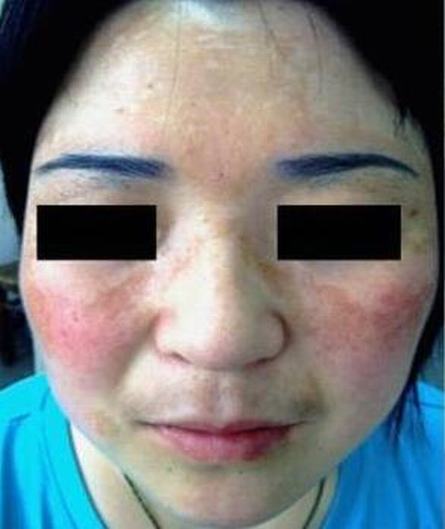 黄褐斑治疗的手法是什么