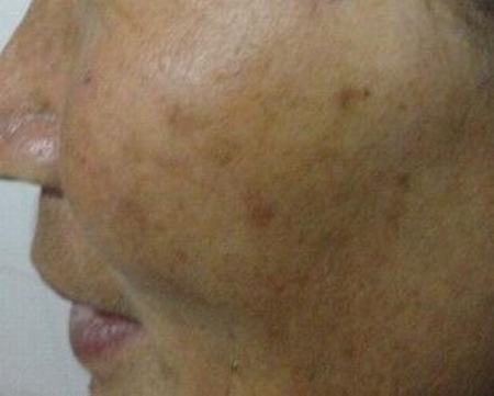 教你如何用中药搞定黄褐斑