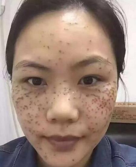 脸颊长黄褐斑怎么调理好呢