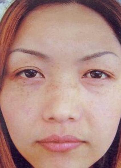 除掉黄褐斑小妙招有哪些呀