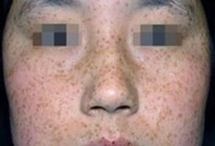黄褐斑的形成有哪些原因