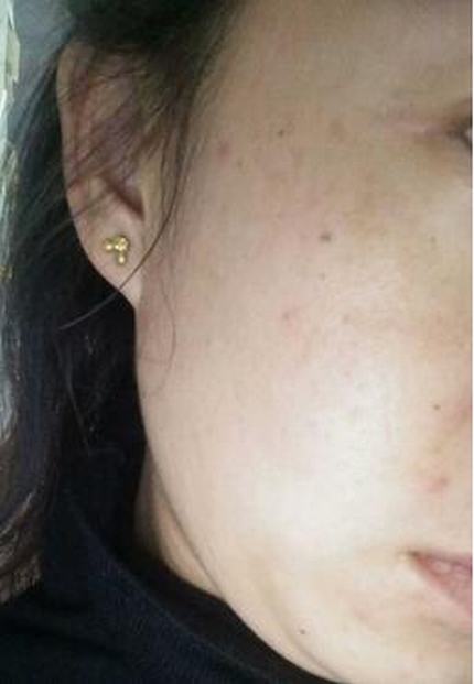 黄褐斑的预防是什么