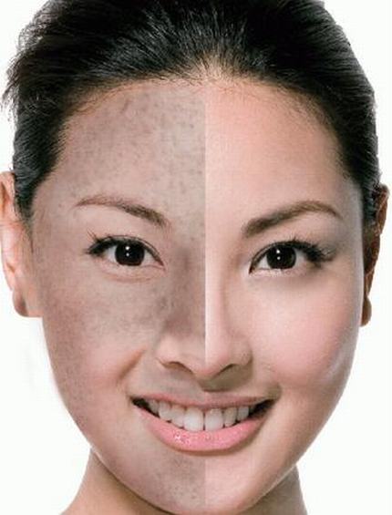 黄褐斑的治疗办法有什么